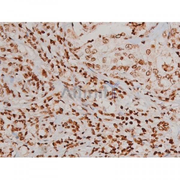 Phospho-Ezrin (Tyr353)[Tyr354] Antibody - AF3173 at 1/200 staining Human liver cancer tissue sections by IHC-P.